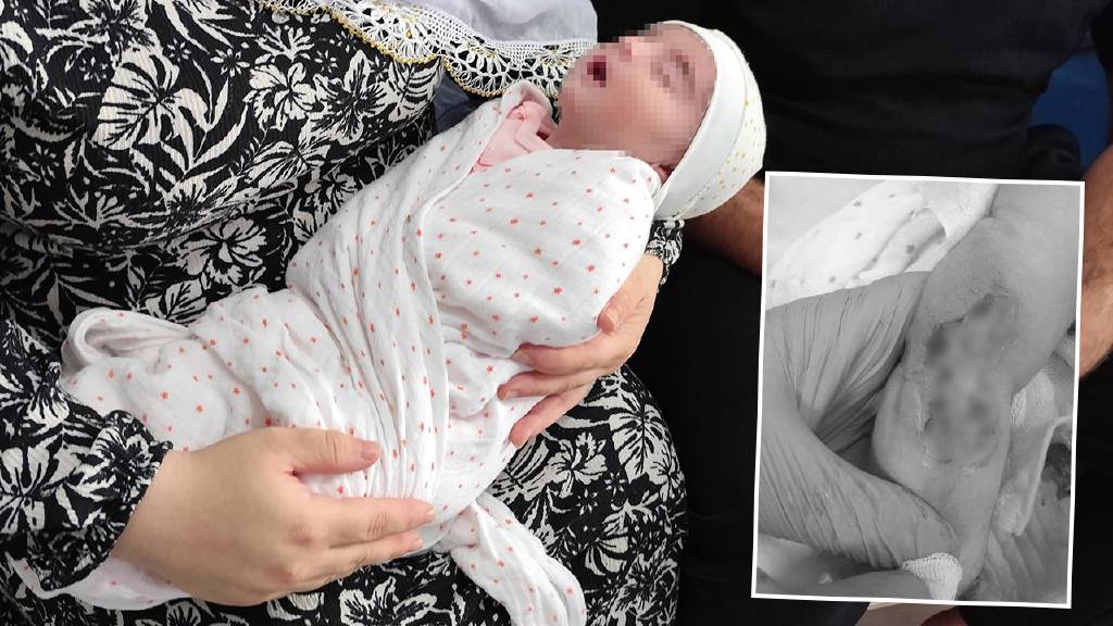 Skandal ihmal! 5 günlük bebeğin kolu feci şekilde yandı...