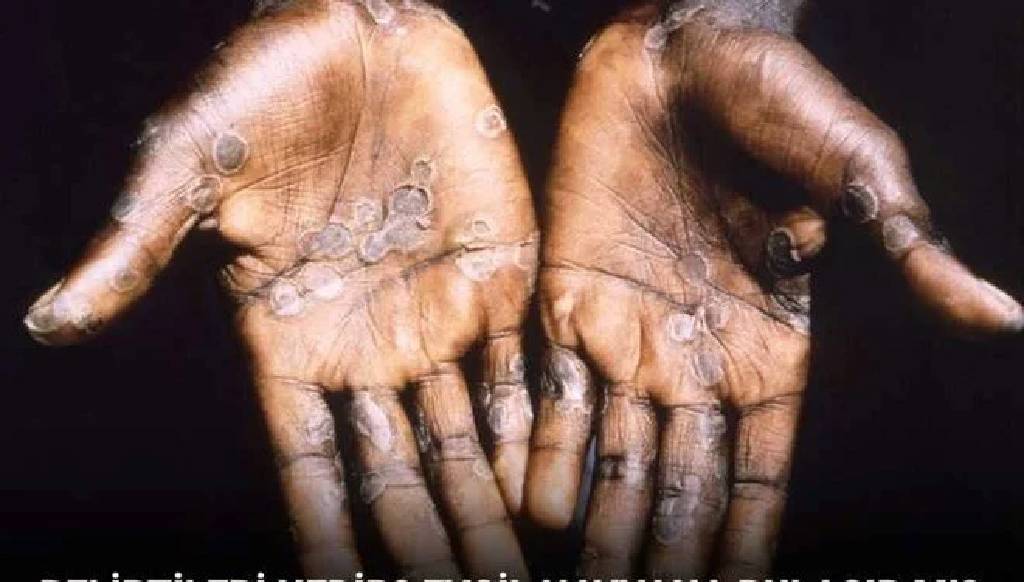 Afrika'da maymun çiçeği alarmı: Salgın kontrolden çıktı