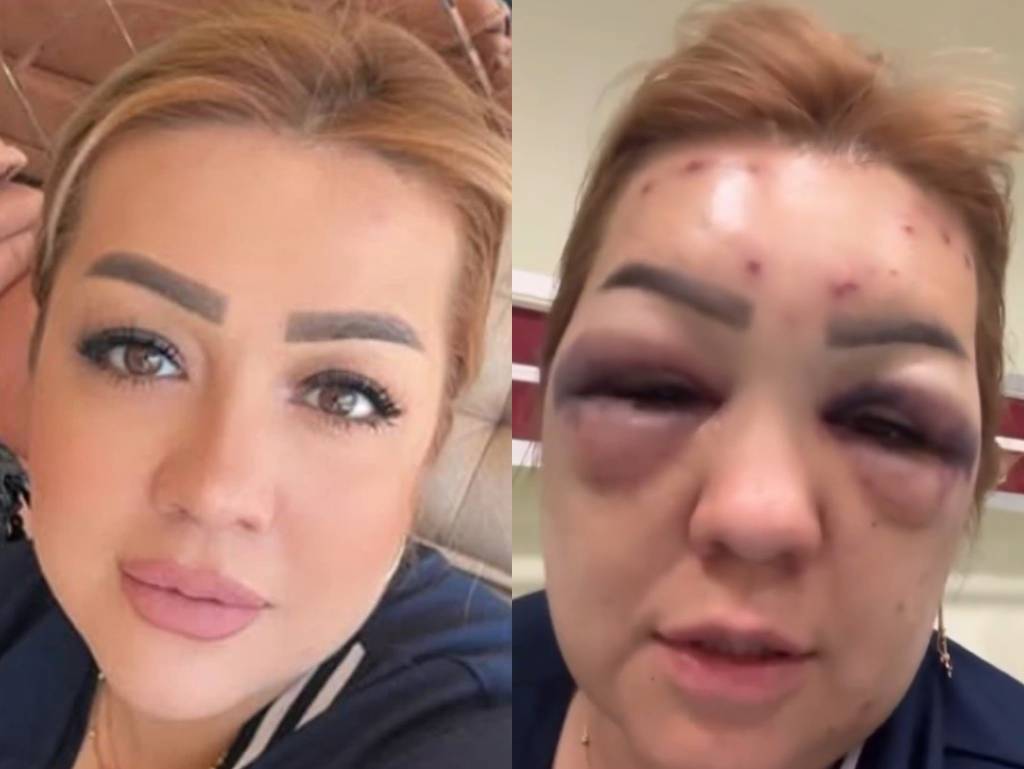 Botoks bu hale getirdi! ‘Doktor harici kimseye yaptırmayın’